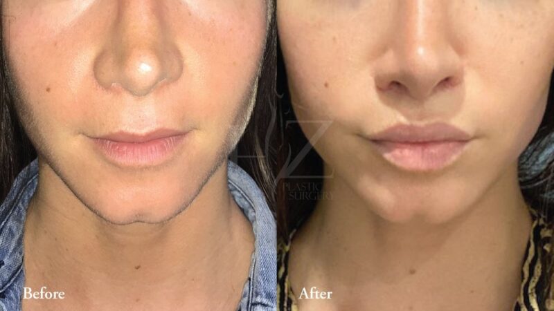 The Visual Benefits of Lip Lift Before and After Treatments